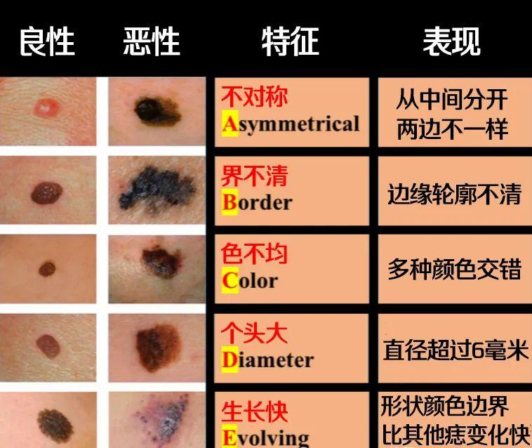 痣长在哪里最危险痣长在哪里最危险，解析危险痣相及其潜在风险