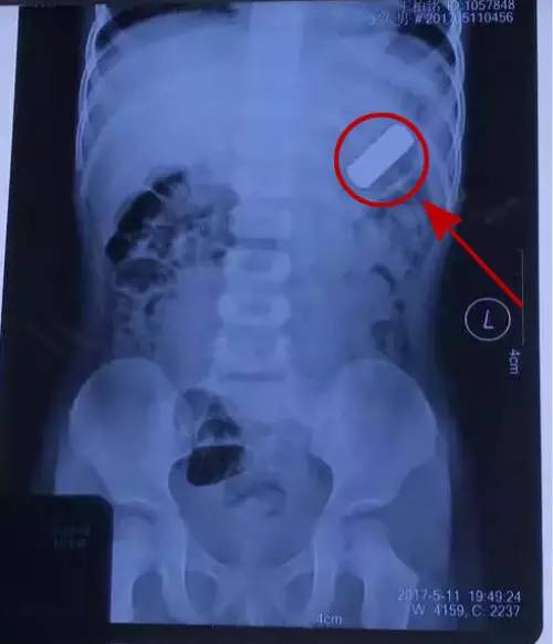 幼儿误吞电池10小时致终身残疾